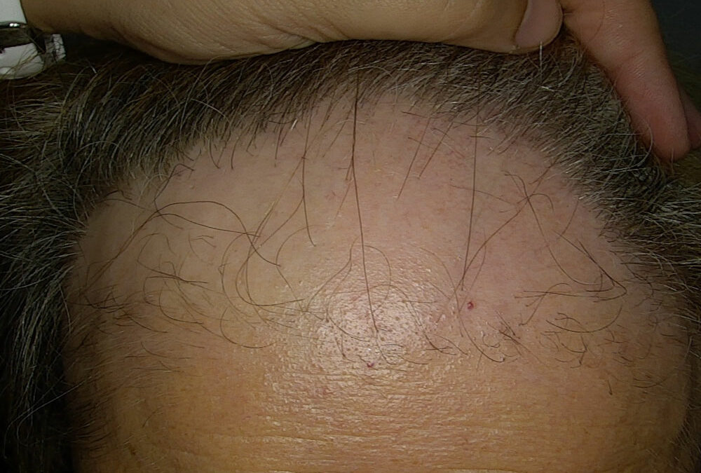 Alopecia Fibrosante Frontale